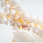 Bel Kayması (Spondilolistezis) ve Ameliyatı Hakkında Bilmeniz Gerekenler