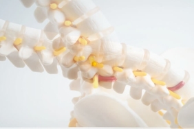 Bel Kayması (Spondilolistezis) ve Ameliyatı Hakkında Bilmeniz Gerekenler