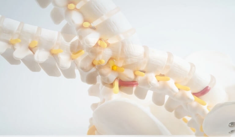 Bel Kayması (Spondilolistezis) ve Ameliyatı Hakkında Bilmeniz Gerekenler